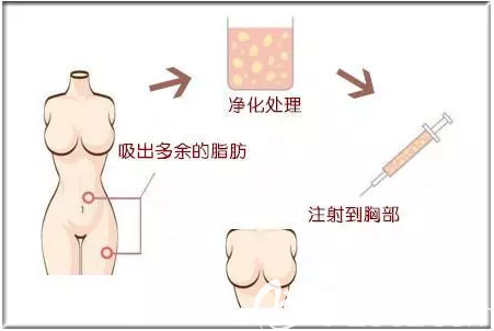 自体脂肪丰胸图解