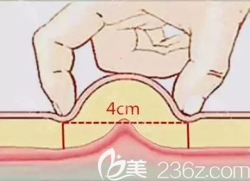两个手指捏起脂肪够4公分