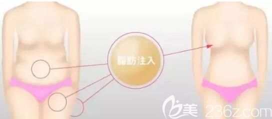将腹部脂肪转移到胸部