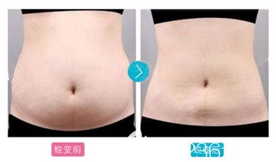 驻马店缔莱美分层腰腹吸脂案例
