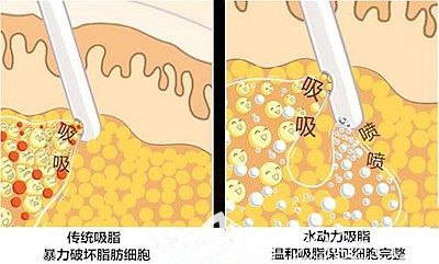 驻马店缔莱美分层腰腹吸脂优势