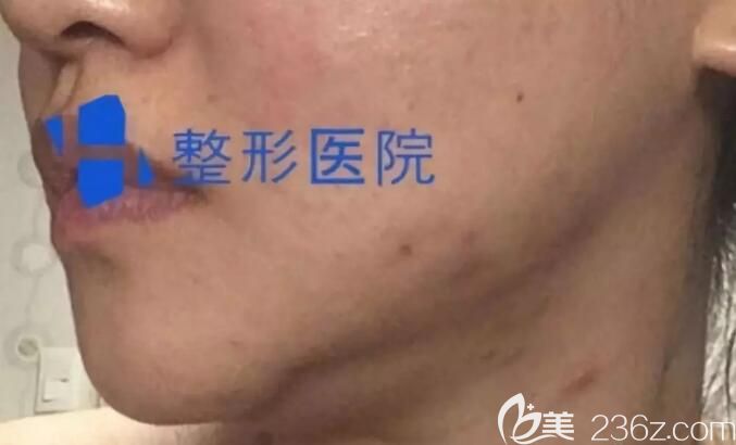 韩国H医院下颌角整形失败修复术前照片
