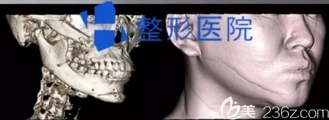 韩国H整形医院下颌角修复术前CT图片