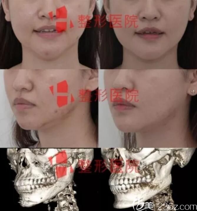 韩国H整形医院白汀桓下颌角修复案例对比图
