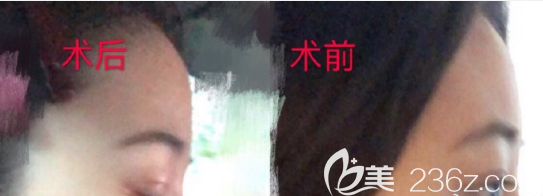 韩国boneps骨水泥填充额头真人案例 韩国boneps骨水泥填充额头真人案例