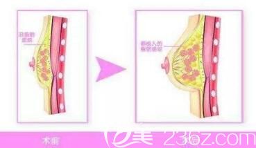 注射自体脂肪丰胸效果示意图