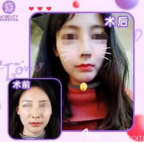 昆明美伊莱整形全切双眼皮案例效果对比图