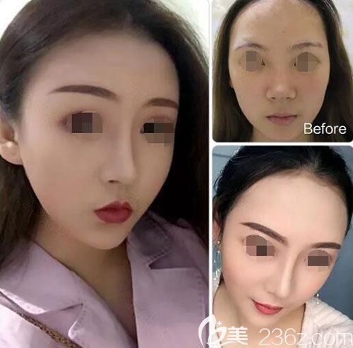 美伊莱整形肋软骨隆鼻+耳软骨垫鼻尖案例效果对比图