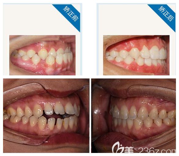 瑞鲨口腔矫正的效果分享 瑞鲨口腔矫正的效果分享