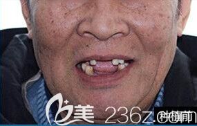 65岁的朱老伯在北京瑞鲨口腔让于洪海院长种植牙之前 65岁的朱老伯在北京瑞鲨口腔让于洪海院长种植牙之前