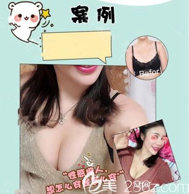 洛阳华美PRP自体脂肪丰胸实例