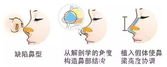 鼻缺陷手术流程