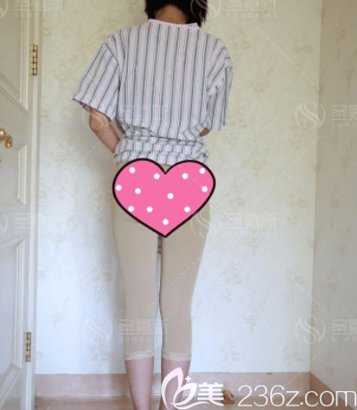 杨佳琦医生给我做腿部吸脂第3天样子