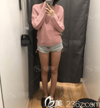 我在北京圣嘉新做腿部吸脂一个月效果