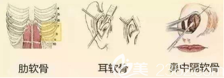 自体软骨隆鼻的材料