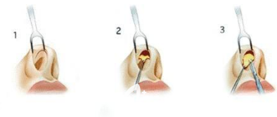 假体隆鼻手术流程