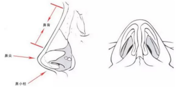 假体隆鼻对比图片