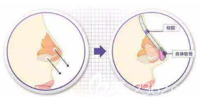 假体隆鼻手术示意图