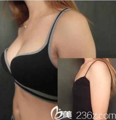 洛阳华美田会建院长自体脂肪丰胸 洛阳华美田会建院长自体脂肪丰胸