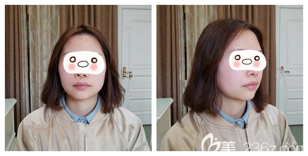 面诊南京韩辰术前唇部较厚 面诊南京韩辰术前唇部较厚