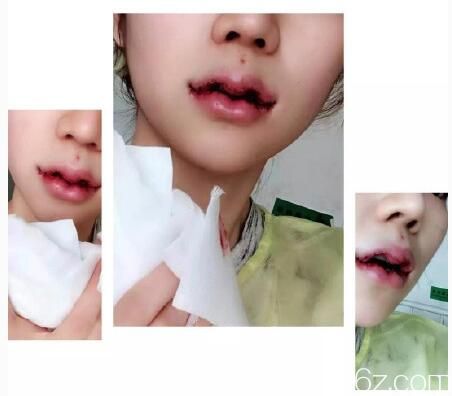 刚做完厚唇改薄+微笑唇术后即刻 刚做完厚唇改薄+微笑唇术后即刻