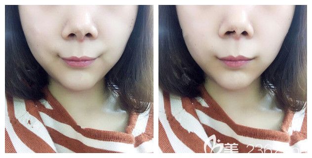 唇部整形术后半月消肿恢复 唇部整形术后半月消肿恢复