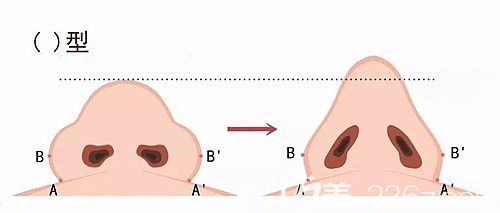 鼻翼肥厚宽大会影响鼻型的精致感