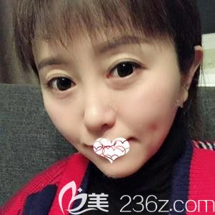 <!--<i data=20240703-sp></i>-->东院长刚为我注射玻尿酸垫下巴术后有点肿胀 <!--<i data=20240703-sp></i>-->东院长刚为我注射玻尿酸垫下巴术后有点肿胀