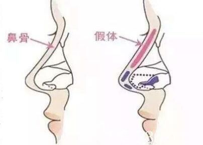 假体隆鼻后遗症有那些？