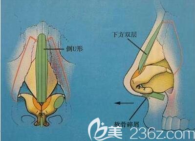 假体隆鼻一定会出现后遗症吗？