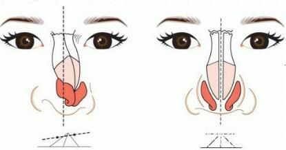 假体隆鼻出现后遗症应该怎么办呢？