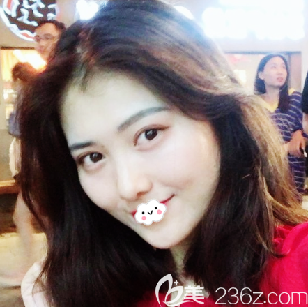 广州广大整形医院王政医生双眼皮<span style= 广州广大整形医院王政医生双眼皮<span style=