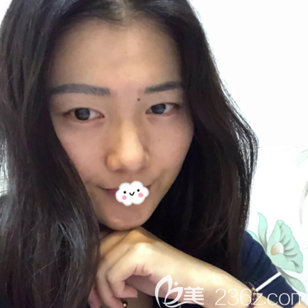 在广州广大整形医院做双眼皮术前照片 在广州广大整形医院做双眼皮术前照片