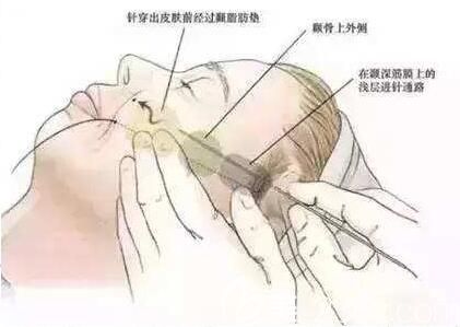 面部埋线提升