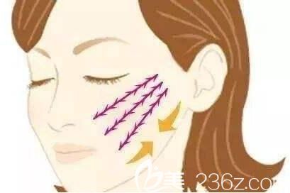 埋线提升能够改变面部衰老吗？