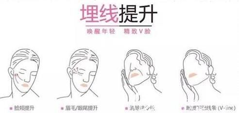 面部埋线提升能够维持多久？