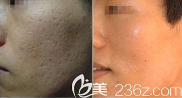 小哥哥已经用激光改善了自己的毛孔粗大 小哥哥已经用激光改善了自己的毛孔粗大