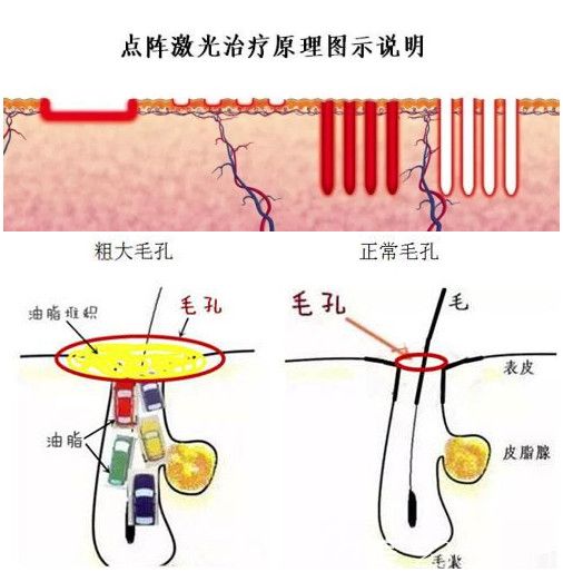 点阵激光改善毛孔粗大原理 点阵激光改善毛孔粗大原理