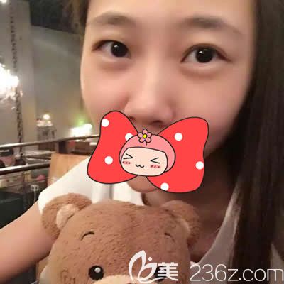 找泉州欧菲胡利韬主任做双眼皮术前照 找泉州欧菲胡利韬主任做双眼皮术前照