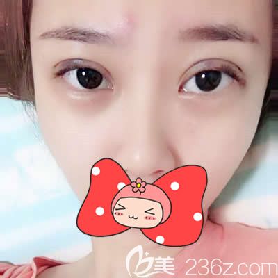 泉州欧菲胡利韬主任为我做双眼皮术后一周效果 泉州欧菲胡利韬主任为我做双眼皮术后一周效果