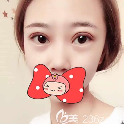 泉州欧菲胡利韬主任为我做双眼皮术后10天照片 泉州欧菲胡利韬主任为我做双眼皮术后10天照片