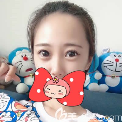 泉州欧菲胡利韬主任为我做双眼皮术后20天效果 泉州欧菲胡利韬主任为我做双眼皮术后20天效果