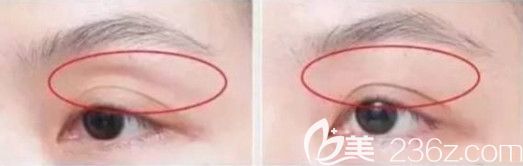 自体脂肪填充眼窝案例