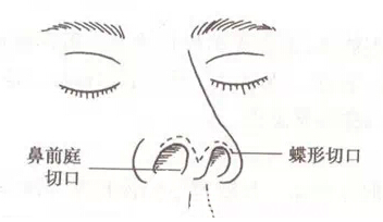 鼻部前庭和蝶形切口
