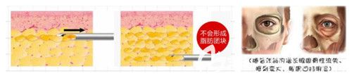 填充眼窝用自体脂肪的优点