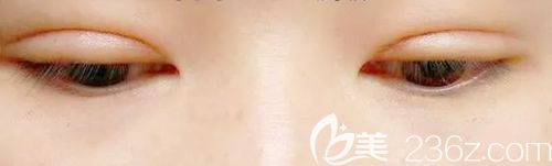 做完双眼皮手术后1年后还有肉条