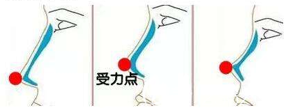 假体隆鼻受力点