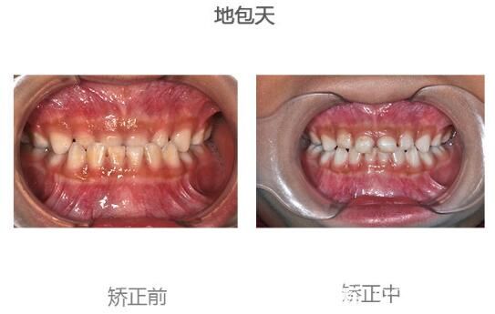 昆明尚爱韩美口腔申晶小孩子地包天矫正案例 昆明尚爱韩美口腔申晶小孩子地包天矫正案例