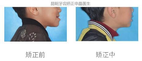 通过申晶院长牙齿矫正案例和顾客评价来看口腔北京路怎么样？