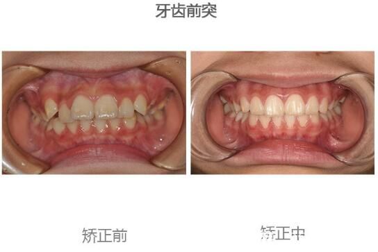 尚爱韩美口腔申晶小姑娘牙齿前突矫正案例 尚爱韩美口腔申晶小姑娘牙齿前突矫正案例